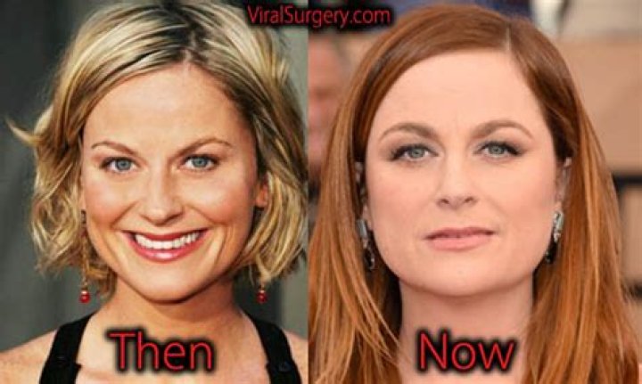 Amy Poehler Plastic Surgery Before and After