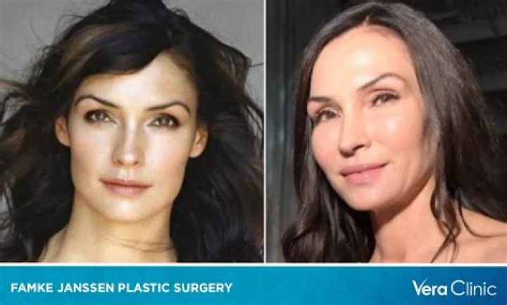 Famke Janssen Plastic Surgery Before and After Botox Injections