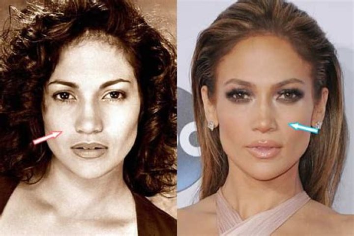 Has Jennifer Lopez had Plastic Surgery: From Rumors to Reality