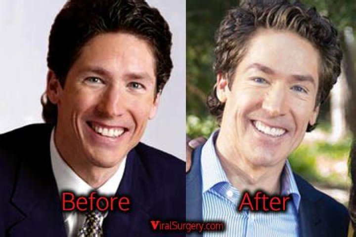 Joel Olsteen Plastic Surgery: Everything You Need to Know About His Surgery