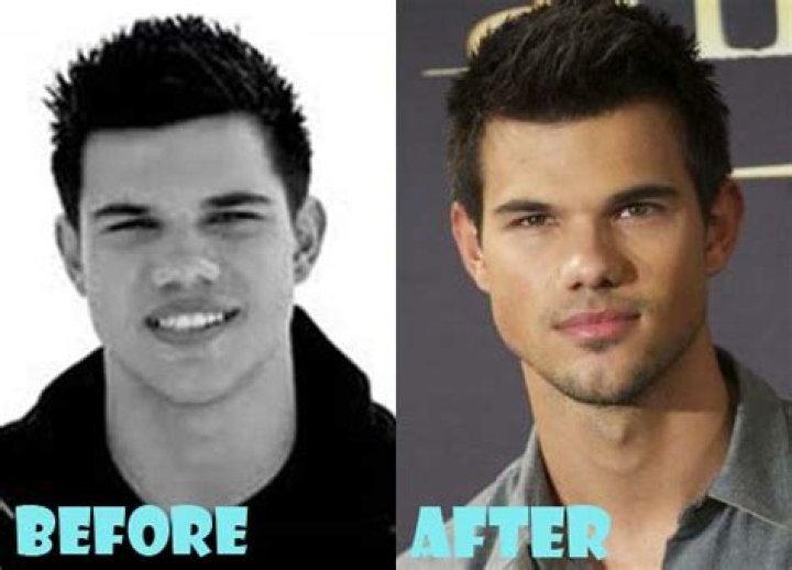 Taylor Lautner Plastic Surgery Before and After